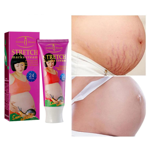 Perfect Dealz Snail Stretch Marks Cream