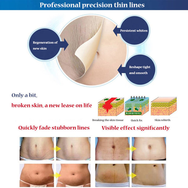 Perfect Dealz Snail Stretch Marks Cream