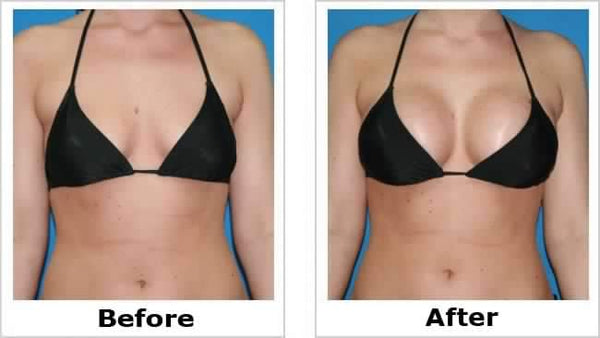 Before and after images showing results of Breast Enlarging Cream on bust appearance.